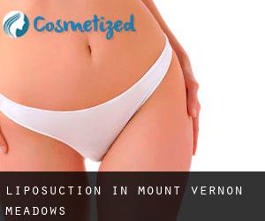 Liposuction in Mount Vernon Meadows