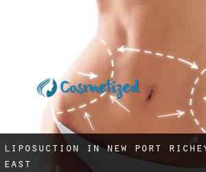 Liposuction in New Port Richey East