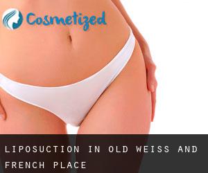 Liposuction in Old Weiss and French Place