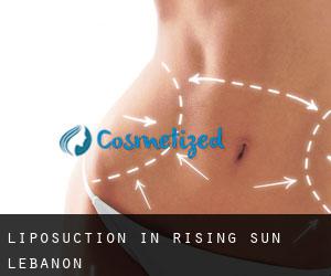 Liposuction in Rising Sun-Lebanon