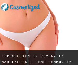 Liposuction in Riverview Manufactured Home Community