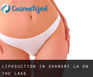 Liposuction in Shangri-La on the Lake