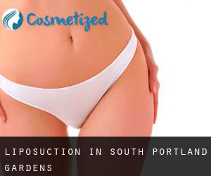 Liposuction in South Portland Gardens Liposuction in South Portland Gardens