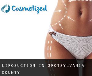Liposuction in Spotsylvania County Liposuction in Spotsylvania County