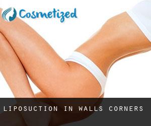 Liposuction in Walls Corners