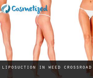 Liposuction in Weed Crossroad