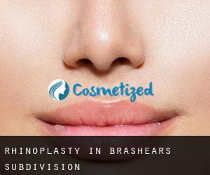 Rhinoplasty in Brashears Subdivision