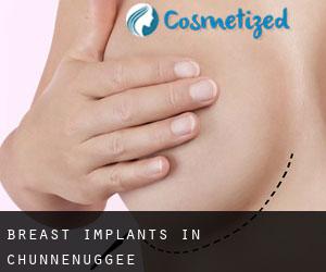 Breast Implants in Chunnenuggee