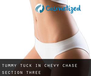 Tummy Tuck in Chevy Chase Section Three
