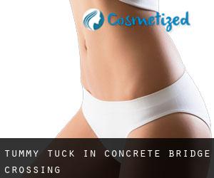Tummy Tuck in Concrete Bridge Crossing