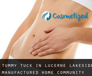 Tummy Tuck in Lucerne Lakeside Manufactured Home Community