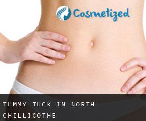 Tummy Tuck in North Chillicothe